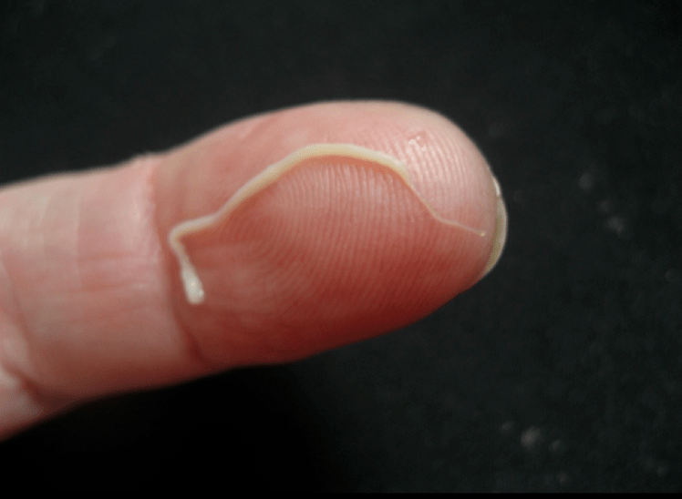 a parasite of roundworms from the human body